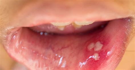 hpv symptoms in mouth
